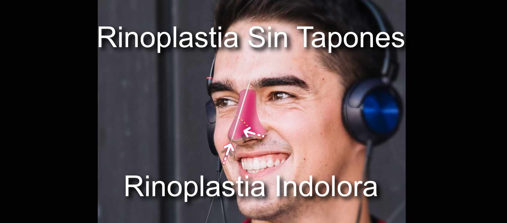 rinoplastia-sin-tapones-sin dolor